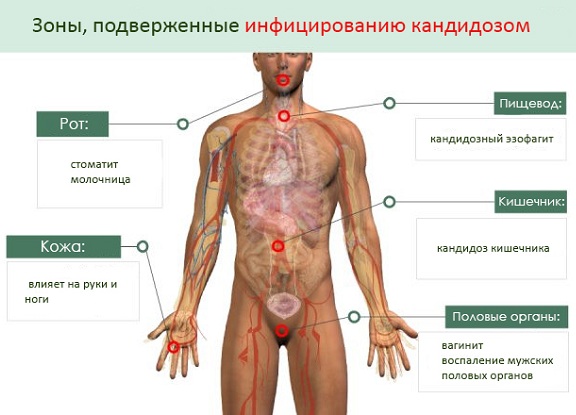 Зуд и жжение в интимной зоне у женщин при сахарном диабете: лечение