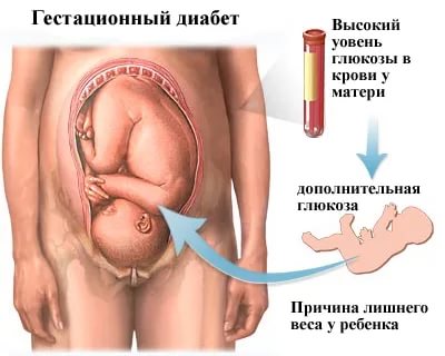Сахарный диабет у беременной: влияние на плод гипергликемии матери Сахарный диабет у беременной: влияние на плод гипергликемии матери