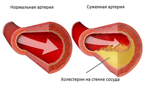 Последствия ампутации ног при сахарном диабете
