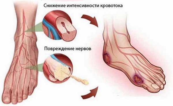 Осложнения сахарного диабета на поздней стадии