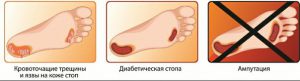 Гангрена ноги: фото, начальная стадия при сахарном диабете 1 и 2 типа