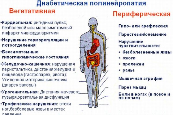 Диагностика и лечение диабетической полинейропатии