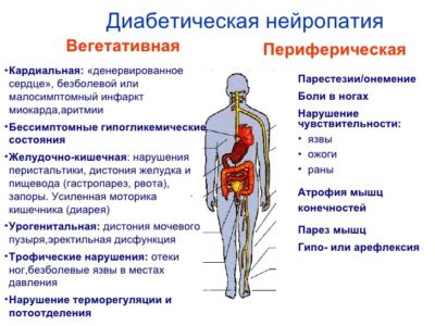 Диабетическая нейропатия: симптомы и лечение, что это такое?