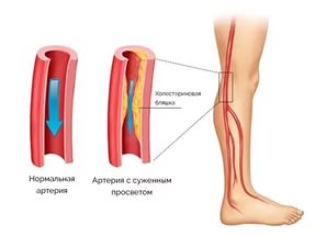 Диабетическая ангиопатия: причины, симптомы и лечение