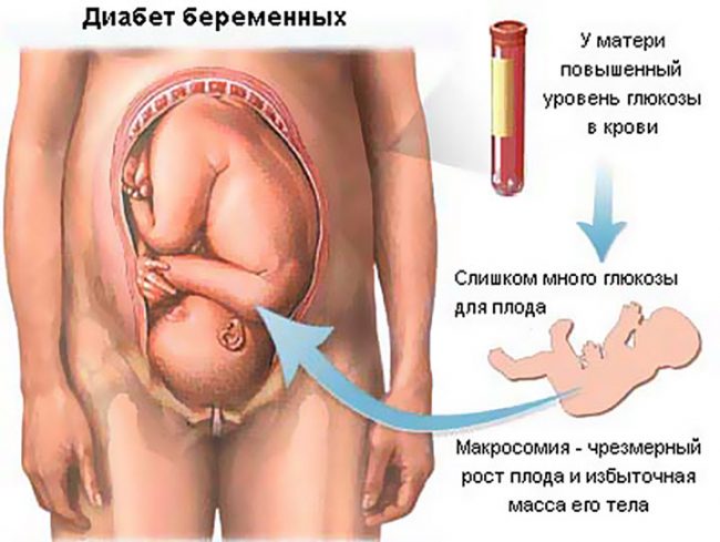 Как проходят роды при гестационном сахарном диабете?