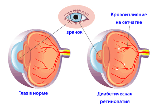 Ретинопатия при сахарном диабете: симптомы и лечение